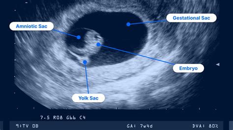 7-Week Ultrasound: Pictures, Heartbeat, Twin Pregnancy and More