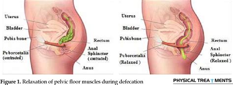 [PDF] SYSTEMATIC REVIEW: THE ROLE OF PELVIC FLOOR MUSCLES DYSFUNCTION ...