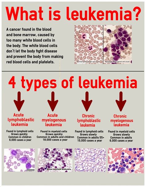 Leukemia | Dr. Farrah Cancer Center