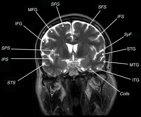 Superior Temporal Gyrus Mri