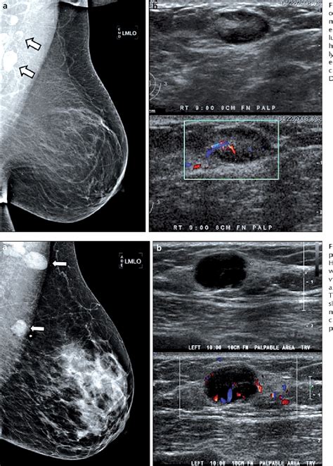 Figure 1 from Abnormal axillary lymph nodes on negative mammograms ...