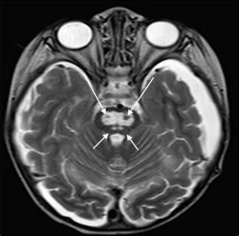 Pontine infarct caused by basilar occlusion in a 1-day-old boy. a, b ...