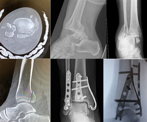 Bimalleolar fracture - dietwest