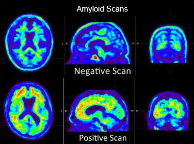 How To Diagnose Alzheimer's Disease - Askexcitement5