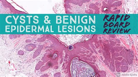 Epidermal Inclusion Cyst Histology