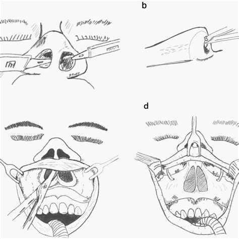 Artistic depiction of a CFR approach. a The basic incision begins with ...