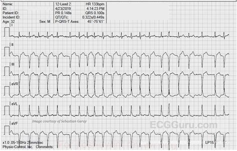 Atrial fibrillation | ECG Guru - Instructor Resources