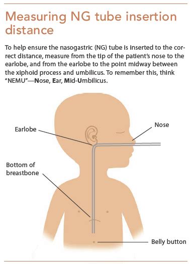 Verifying NG feeding tube placement in pediatric patients