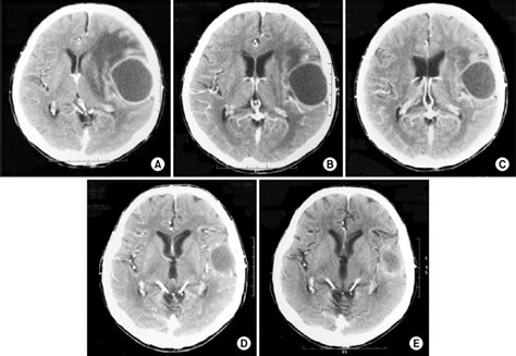 Contrast-enhanced brain computed tomography (CT) scanning of patient ...