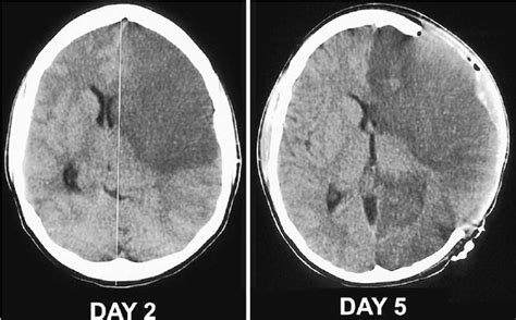 Fig. 4. Hemicraniectomy in a 35-year-old woman with malignant left MCA ...