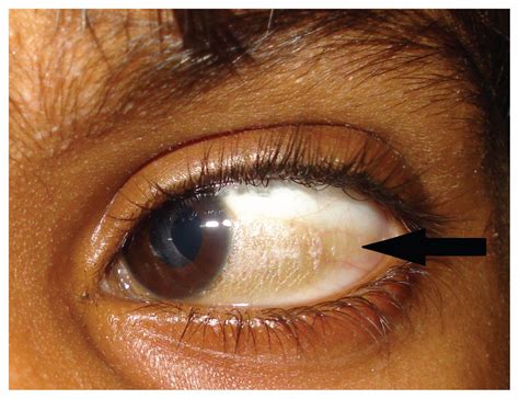 Causes and treatment of Xerosis of conjunctiva