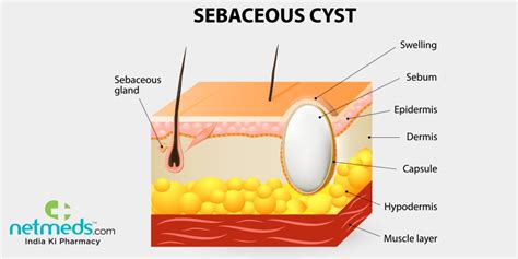 Epidermal Cyst