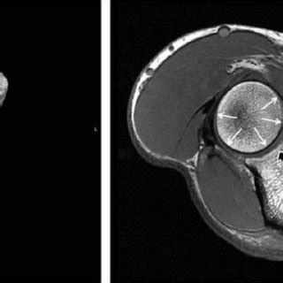 Radial head and radial fossa. In extreme flexion, the radial head ...