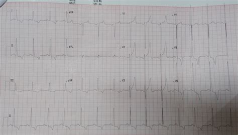 Cardiology window: Left ventricular hypertrophy with LV strain pattern