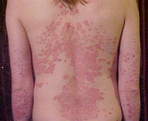 Erythrodermic psoriasis: Causes, symptoms, and diagnosis