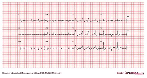 Atrial Fibrillation: Atrial Fibrillation On An Ekg