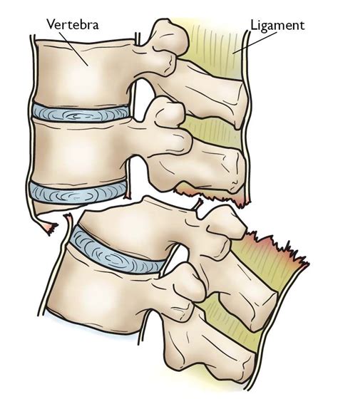 Types Of Lumbar Fractures - Design Talk