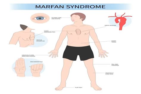 Marfan Syndrome: Understanding the Genetic Disorder