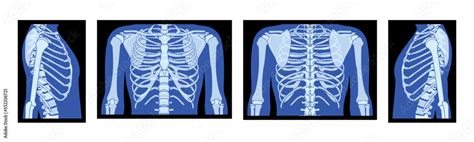 Set of X-Ray rib cage and hands Skeleton Human body Bones adult people ...