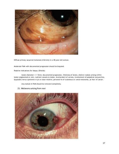 Conjunctival tumors