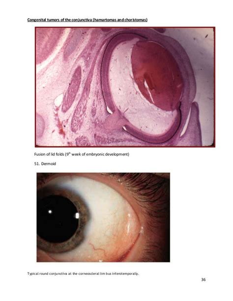 Conjunctival tumors