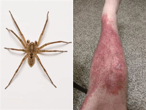 Brown Recluse Spider Bite Thumb