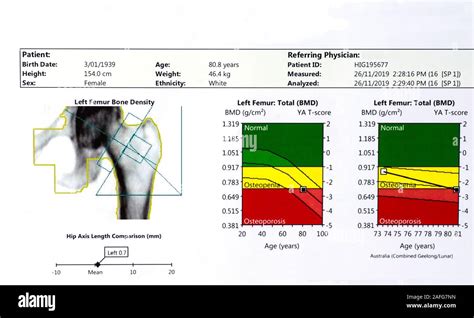 Left Femur Bone Density Scan and comparison chart of a female aged 80 ...