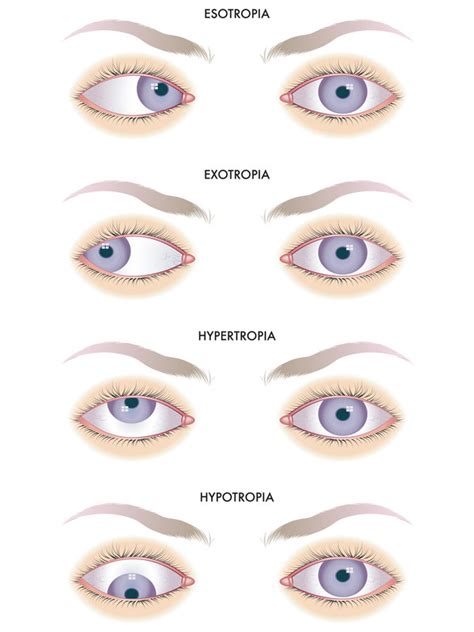 Strabismus - Stereo Optical