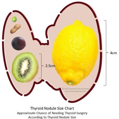 Renowned Surgeons Publish Thyroid Nodule Size Chart During Thyroid ...