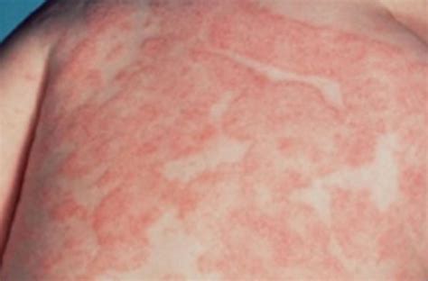 Skin Fungal Rash