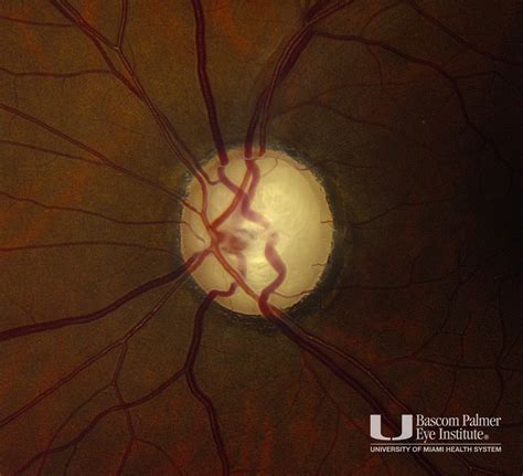 Course: Optic Nerve Cupping from Primary Open Angle Glaucoma