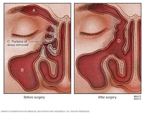 Nasal polyps - Diagnosis and treatment - Mayo Clinic