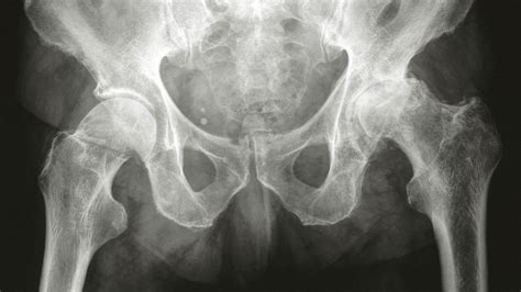 Osteoarthritis Hip X-Ray: Findings, Staging, and More