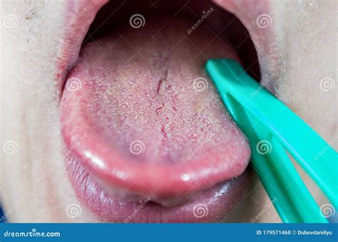 Examination Of The Human Tongue Organ, Diseases And Manifestations Of ...