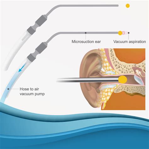 Clinically Proven Ear Wax Removal: Why Microsuction Wins! - Crystal ...