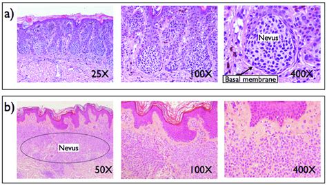 Congenital Melanocytic Nevus Histology