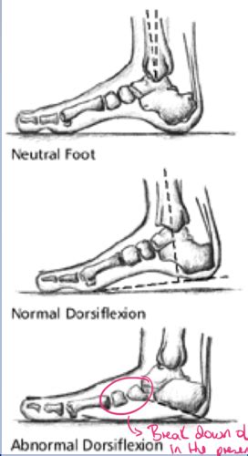Lecture 5.A: Pes Planus Flashcards | Quizlet