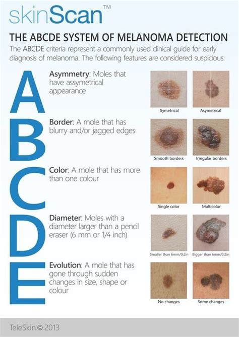 abcde of melanoma - Premier Dermatology Atlanta