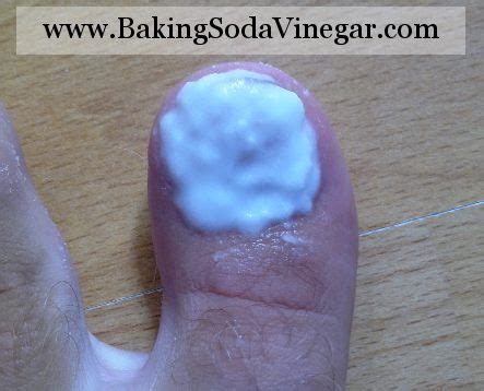 Toenail Fungus Treatment | Baking Soda and Vinegar Uses