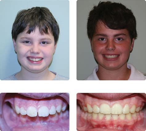 Overbite - J. Cox Orthodontics » J. Cox Orthodontics