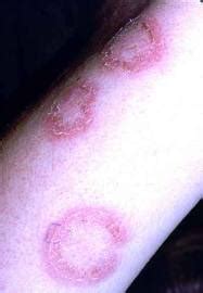 Discoid lupus erythematosus rash treatment