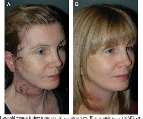 Figure 10 from Deep Plane Extended Vertical Facelift | Semantic Scholar