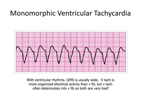 PPT - ACLS Rhythms Cheat Sheet PowerPoint Presentation, free download ...