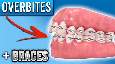 How Do BRACES FIX Overbites? | Overbite Before and After Braces ...