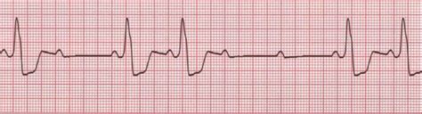 AV Block: 2nd degree, Mobitz II (Hay block) • LITFL • ECG Library