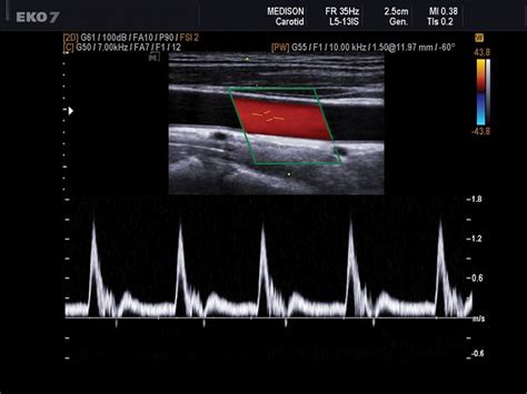 Doppler Ultrasound of the Carotid Arteries - HeartUpdate.com | Medical ...