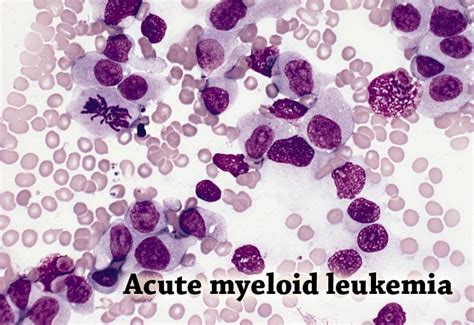 Acute myelogenous leukemia