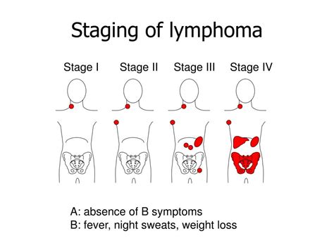 PPT - Lymphoma PowerPoint Presentation - ID:384235