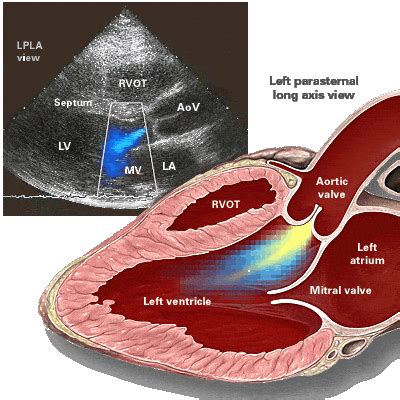 Aortic regurgitation – Symptoms, Causes, and Treatment – Costamedic