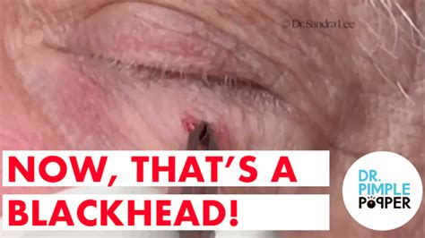 Whiteheads behind the ears, extracted - Bedtime Blackheads - Dr. Pimple ...